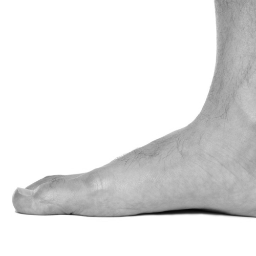 Pieds plats et douleurs: origines et traitements possibles