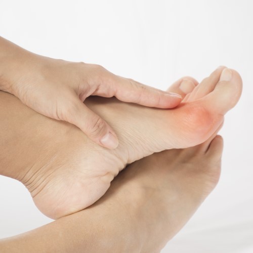 Deux pieds, un qui a clairement un oignon au pied